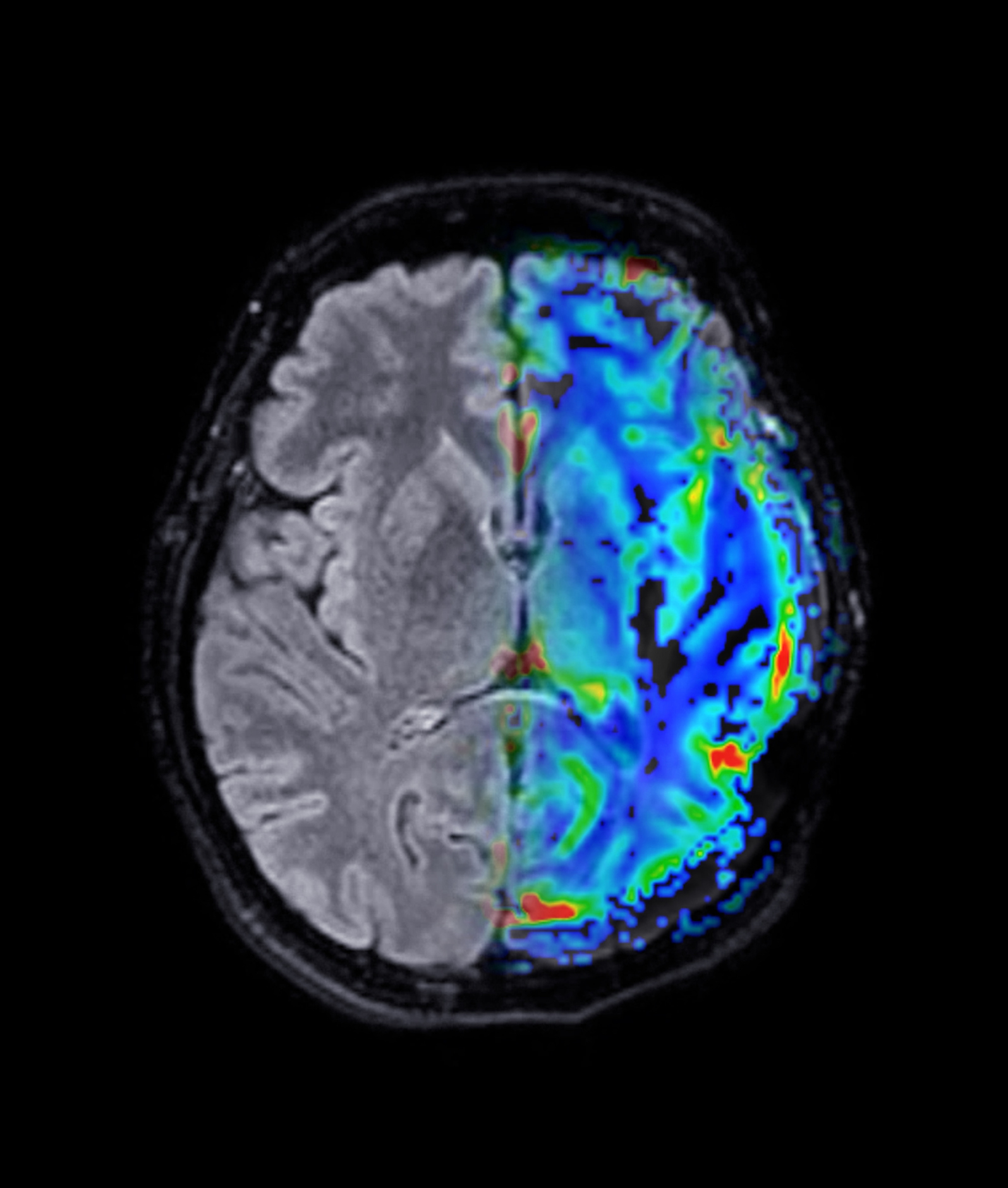 MRI brain perfusion imaging helps assess cerebral blood flow and tissue viability.